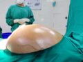 महिला की पेट से निकला 22 किलो का कैंसर ट्यूमर