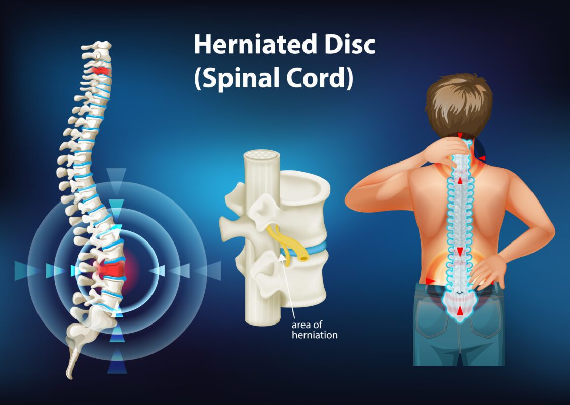 Cauda Equina Syndrome and Ankylosing Spondylitis